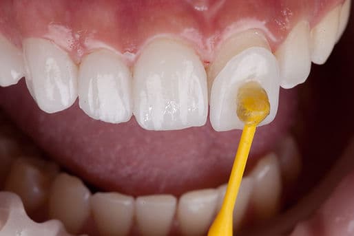 Dental smile design: a set of white porcelain veneers